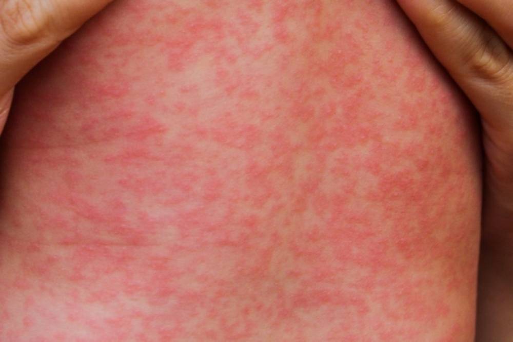 Measles alert for Sydney