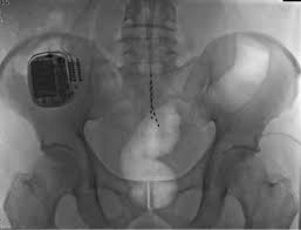 स्पाइनल कॉर्ड स्टिमुलेटर के इस्तेमाल पर डॉक्टरों ने जताई चिंता, रिसर्च में मिले गंभीर जोखिम