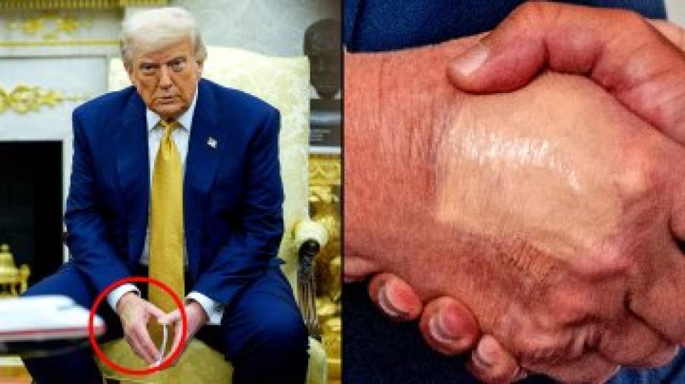 उम्र बढ़ने के कारण ट्रम्प को हुई नसों की समस्या