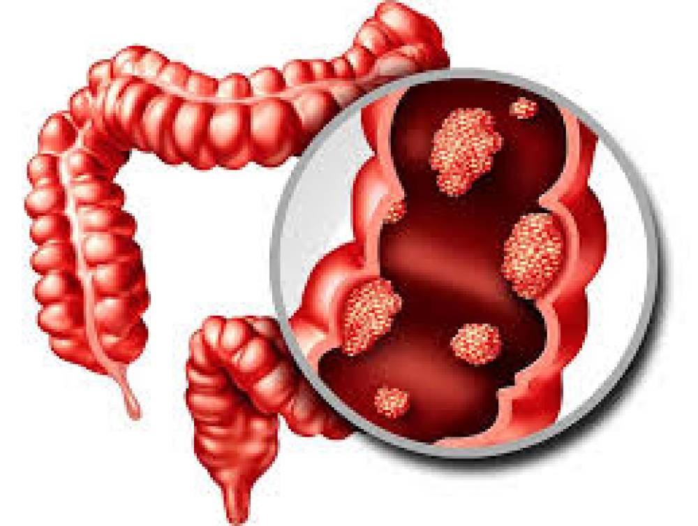 गरीब और अमीर इलाकों में आंत कैंसर जांच का असमान संतुलन