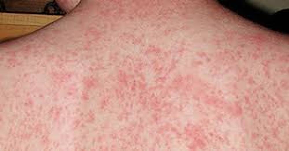 सिडनी में खसरे का अलर्ट, इंडोनेशिया से लौटे यात्री में संक्रमण की पुष्टि